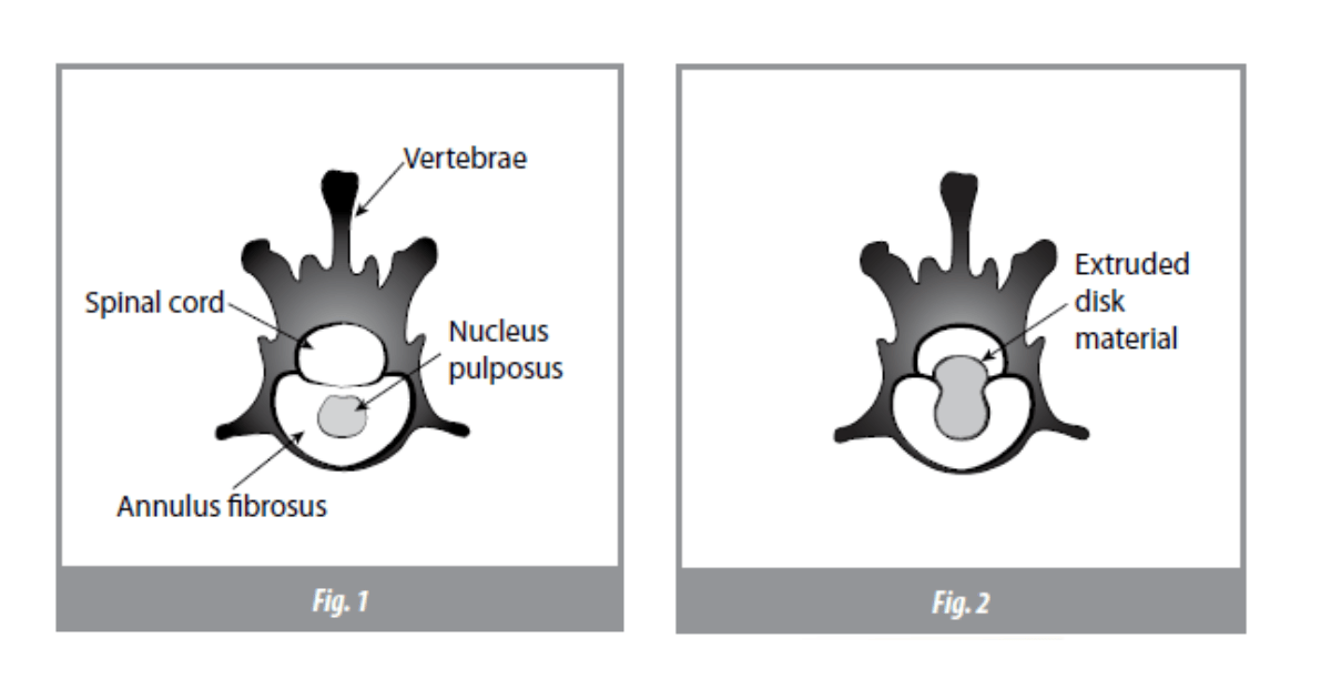 Intervertebral Disk Disease (IVDD) And Treatment In Dogs