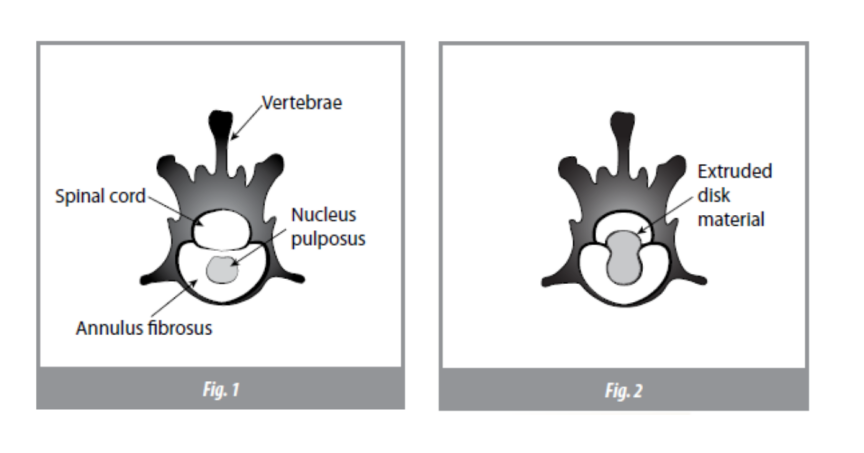 Intervertebral Disk Disease (IVDD) and Treatment in Dogs