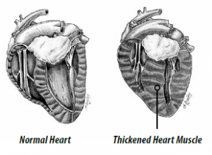 Feline Hypertrophic Cardiomyopathy (HCM)