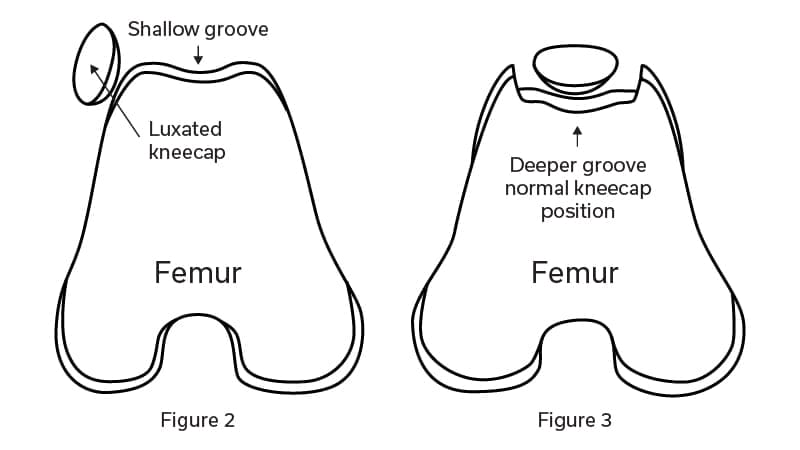 Diagram of figure 2 and figure 3. Figure 2 shows a luxated kneecap and a shallow groove. Figure 3 shows a kneecap in a deeper grove.